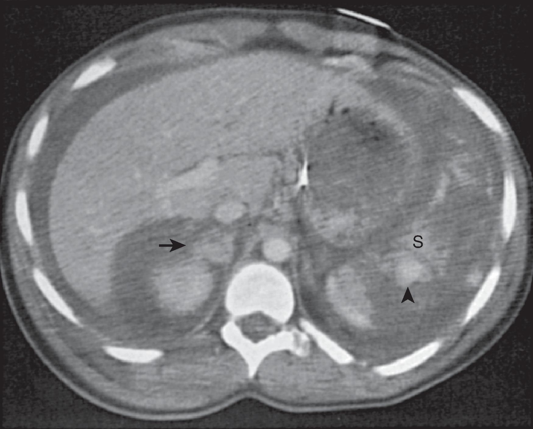 Fig. 63.5, Shattered spleen.