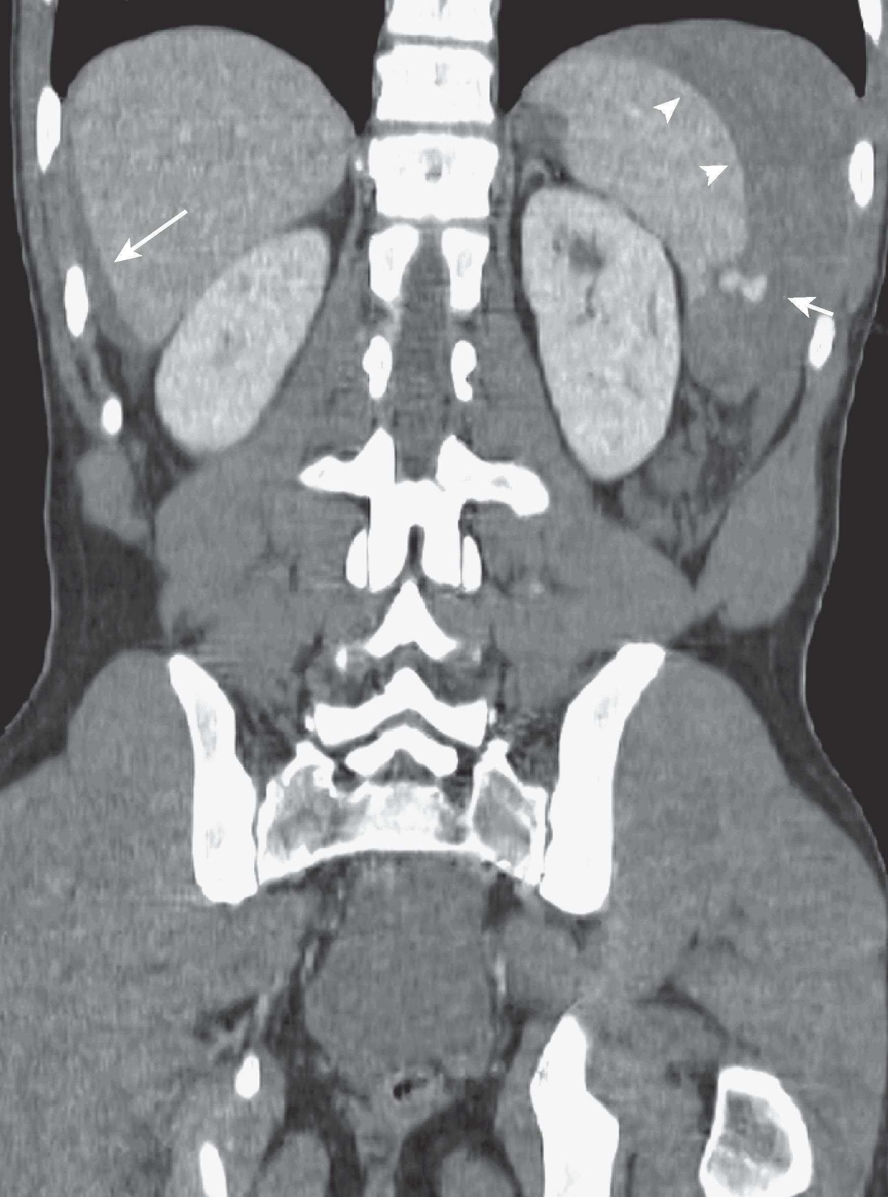 Fig. 63.6, Active extravasation of contrast material.