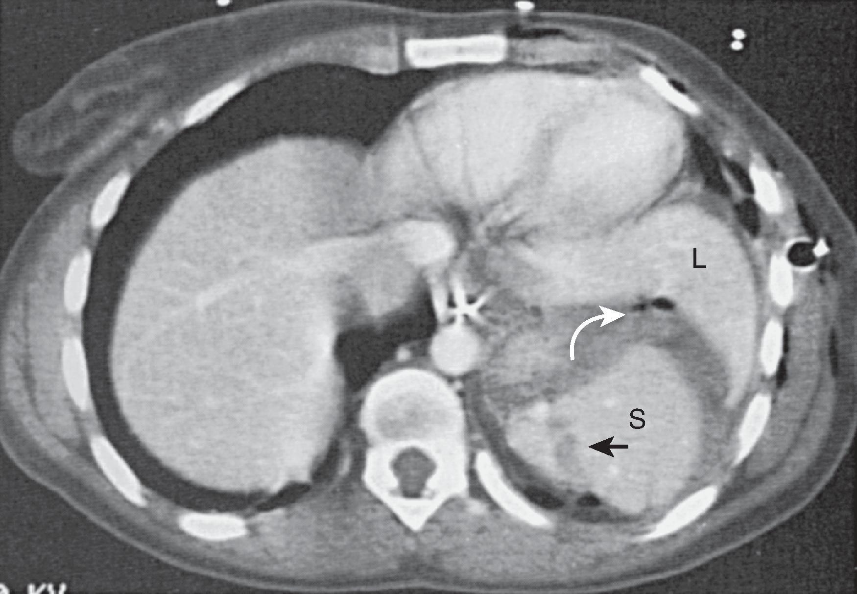 Fig. 63.8, Penetrating splenic injury.