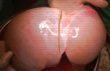 FIGURE 52-1, Left lateral segment/right lobe liver transplantation.