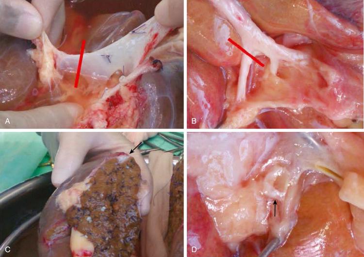 FIGURE 52-2, Ex situ split liver transplantation. Main anatomical structures.