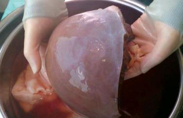 FIGURE 52-3, Right lobe graft (segment IV removed) for split liver transplantation.