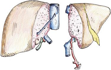 FIGURE 53-1, Full right lobe/left lobe split with preservation of the middle hepatic vein with the left lobe graft and the cava with the right lobe graft. The common artery and portal vein are preserved with the left lobe graft, but the bile duct is preserved with the right lobe graft.