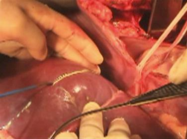 FIGURE 53-3, The line of transection on the hepatic parenchyma is just to the right of the middle hepatic vein.