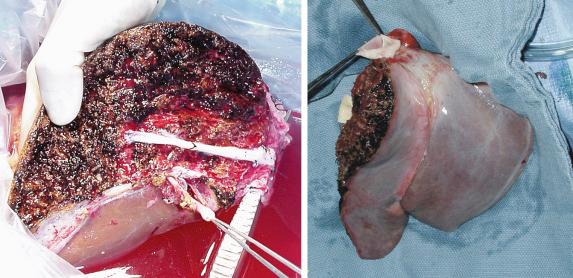 FIGURE 53-5, The split is completed on the back table by final division of the vascular structures. Important middle hepatic vein tributaries of the right lobe can be reconstructed using conduit from the donor.