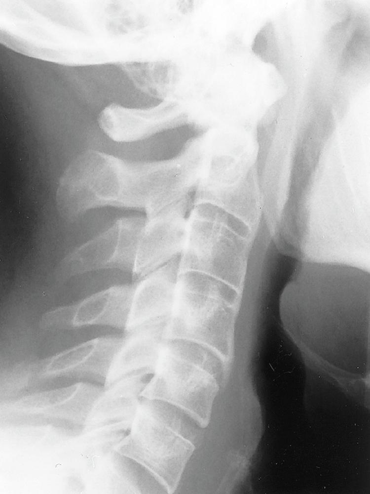 FIGURE 244-4, A 34-year-old man who has had ankylosing spondylitis for 9 years and neck pain.