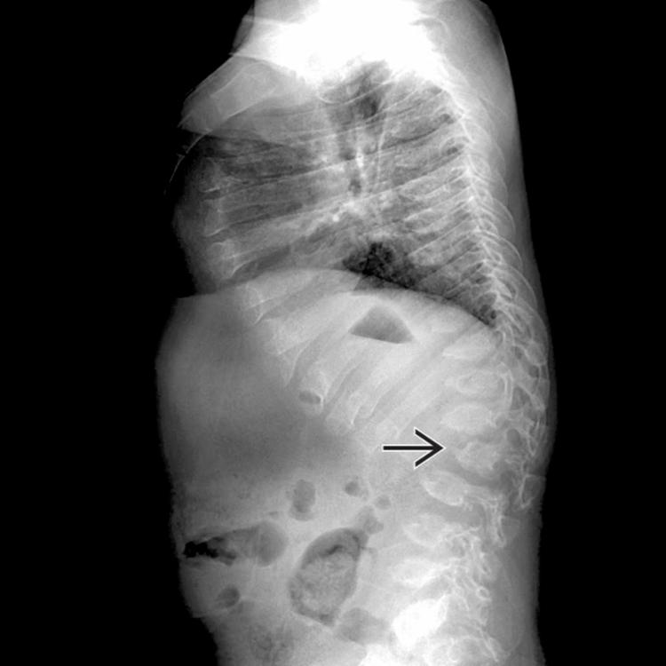 Lateral radiograph of the thoracolumbar spine (kyphosis, myelopathy) demonstrates characteristic platyspondyly in addition to focal kyphosis at the thoracolumbar junction secondary to a hypoplastic L2 vertebra .