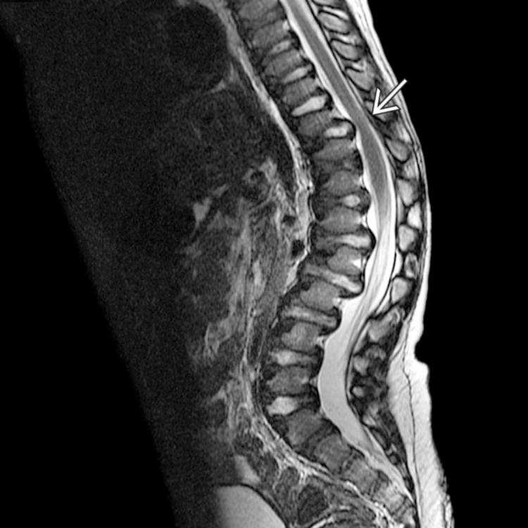 Sagittal T2WI MR (kyphosis, myelopathy) of the thoracolumbar spine confirms significant stenosis of the lower thoracic spinal canal producing focal spinal cord compression and abnormal spinal cord T2 hyperintensity .