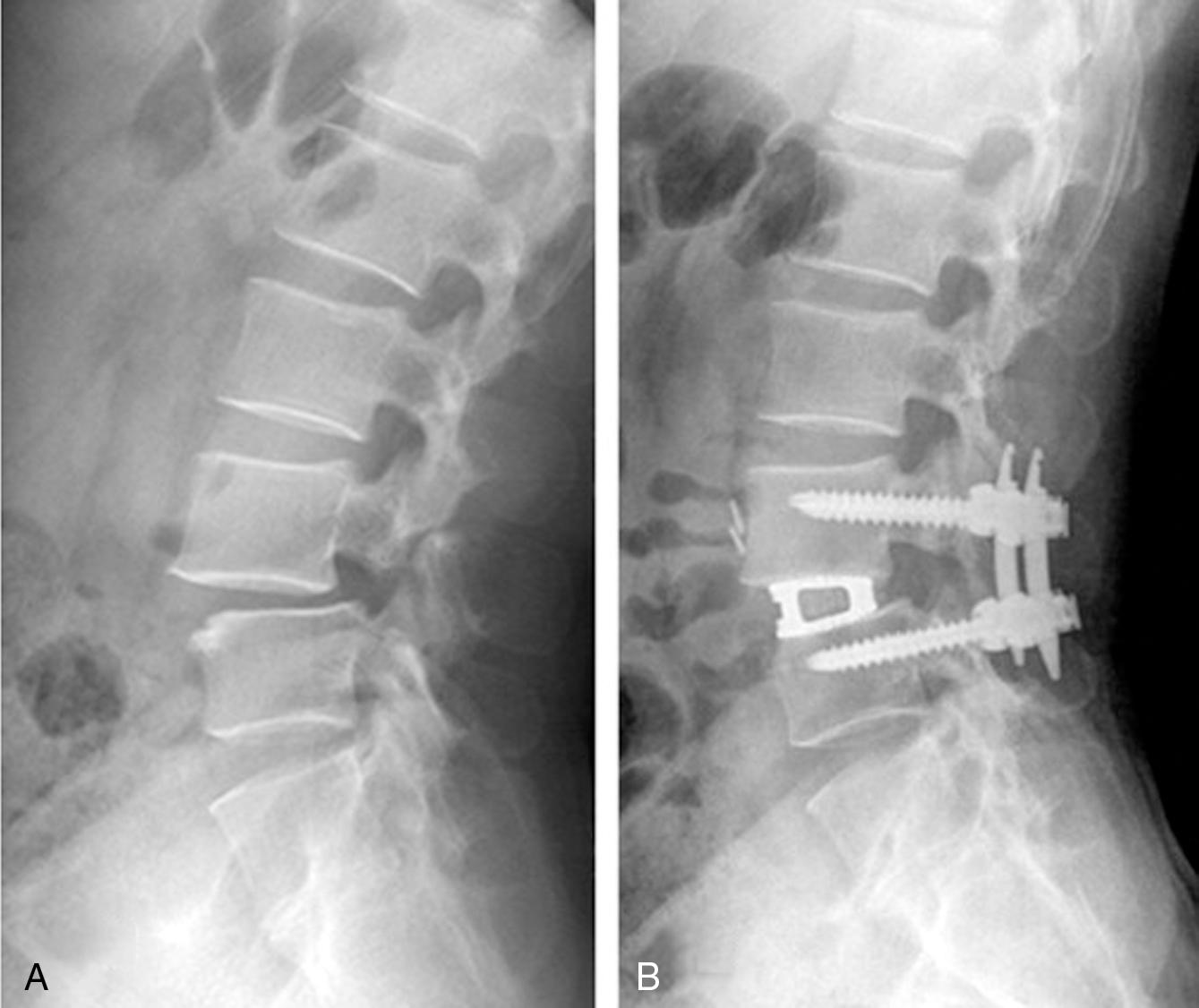 Fig. 53.1, Low-grade adult isthmic spondylolisthesis.