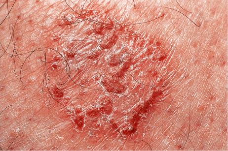 Fig. 6.1, Eczema: this is a plaque of discoid eczema. Small vesicles are present at the edge of the lesion.