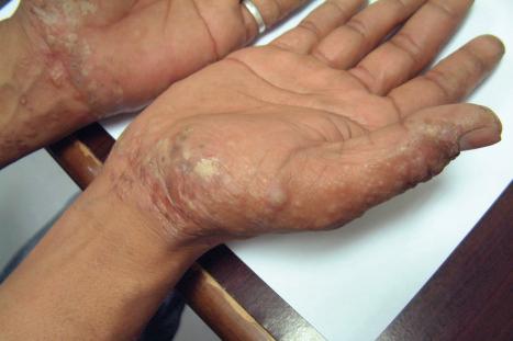 Fig. 6.11, Hand eczema: tense yellow vesicles are present.