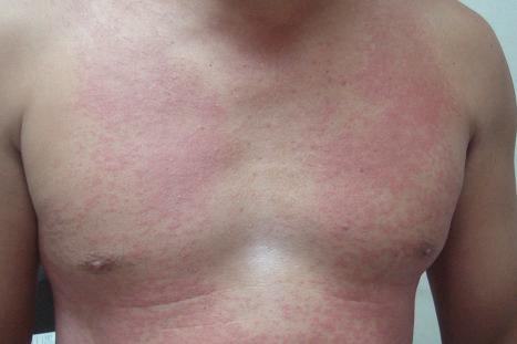 Fig. 6.13, Contact dermatitis: this early erythematous predominantly macular eruption developed as a reaction to fabric softener.