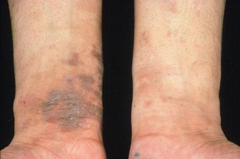 Fig. 6.14, Contact dermatitis: bilateral involvement in a patient using a watch on the right wrist and a leather bracelet on the left wrist.