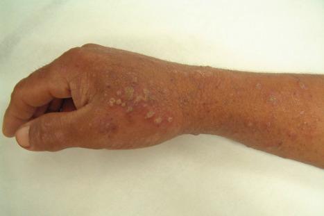 Fig. 6.16, Contact dermatitis: there is a superimposed pustular element due to an infection in this patient with a contact reaction to a domestic antiseptic.