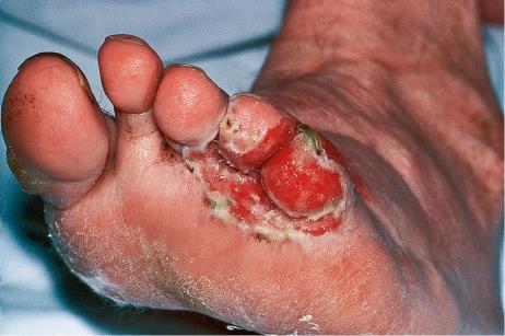 Fig. 6.17, Infective dermatitis: lesions affecting the foot web spaces are often due to staphylococci or streptococci and are associated with excess sweating.