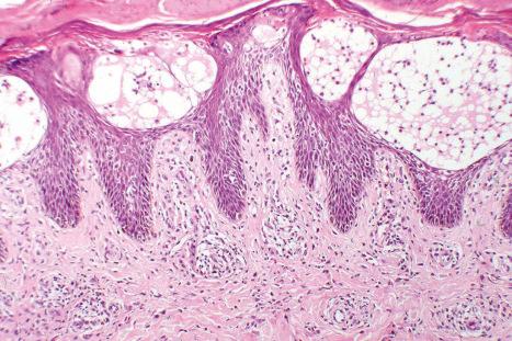 Fig. 6.20, Acute dermatitis: fluid-filled vesicle due to intense spongiosis.