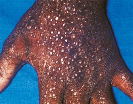 Fig. 6.2, Lichenification: pronounced pebbly lichenification on the dorsum of the hand of a patient with atopic dermatitis. Bizarre forms, as seen here, are not uncommon in black children.