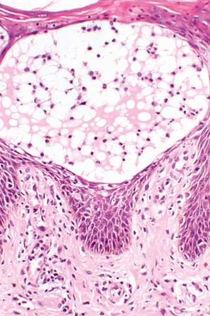 Fig. 6.21, Acute dermatitis: the vesicle contains lymphocytes and occasional eosinophils.