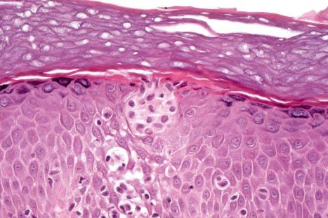 Fig. 6.22, Acute dermatitis: in contact reactions, Langerhans cell-rich vesicles are often present, as shown in this picture. These should not be mistaken for the Pautrier microabscesses of mycosis fungoides.