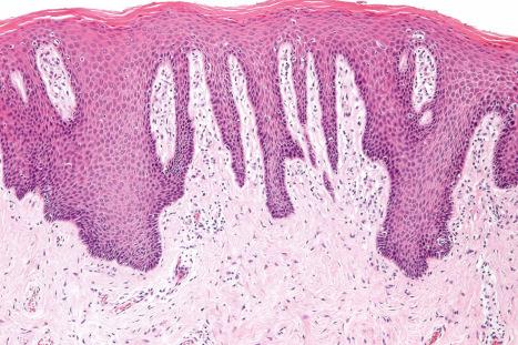 Fig. 6.24, Chronic dermatitis (lichenification): there is hyperkeratosis with hypergranulosis and psoriasiform hyperplasia. The papillary dermis is fibrosed and there is a patchy chronic inflammatory cell infiltrate.