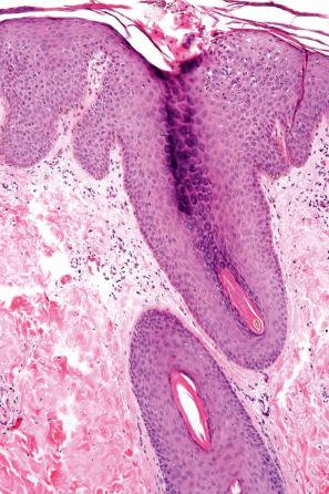 Fig. 6.25, Seborrheic dermatitis.