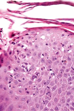 Fig. 6.26, Seborrheic dermatitis: there is parakeratosis, and occasional neutrophils are present.