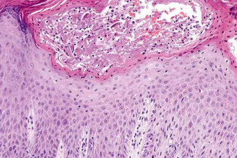 Fig. 6.28, Spongiotic superficial dermatophyte infection: higher-power view.