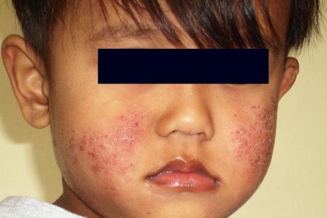Fig. 6.3, Atopic dermatitis: lesions on the face and trunk are particularly seen in infants and young children. This child has bilateral involvement of the cheeks.