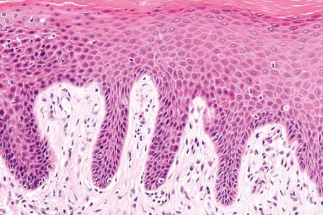 Fig. 6.31, Lichen simplex chronicus: there is hyperkeratosis, patchy parakeratosis, and elongation of the rete ridges.