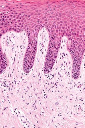 Fig. 6.32, Lichen simplex chronicus: there is hypergranulosis. Note the vertically orientated collagen fibers, a characteristic feature.