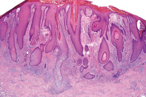 Fig. 6.36, Nodular prurigo: there is hyperkeratosis, hypergranulosis, and pseudoepitheliomatous hyperplasia. The dermis is scarred and there is a perivascular and interstitial chronic inflammatory cell infiltrate.