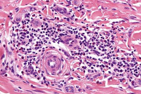 Fig. 6.38, Nodular prurigo: note the conspicuous eosinophils.