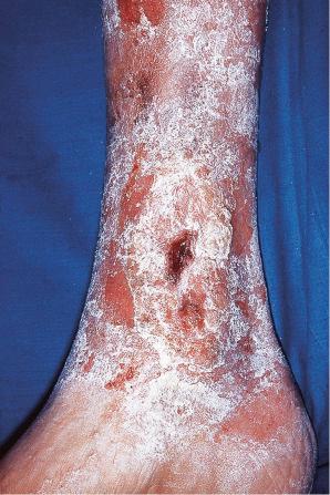 Fig. 6.40, Stasis dermatitis: there is vesiculation, exudation, and crusting on the lower leg around a stasis ulcer, which was precipitated by allergy to the antibiotic dressing.