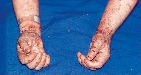 Fig. 6.4, Atopic dermatitis: these crusted, exudative and infected lesions with lichenification are characteristic.