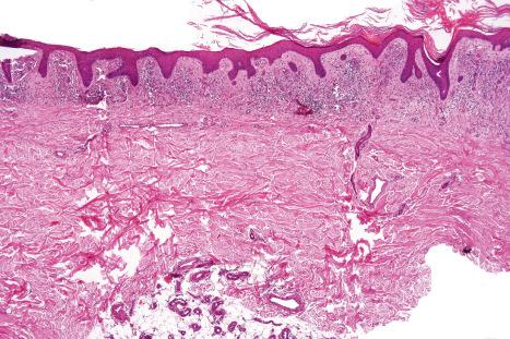 Fig. 6.41, Stasis dermatitis: there is hyperkeratosis, focal parakeratosis and marked epidermal hyperplasia. The dermis is chronically inflamed and scarred.