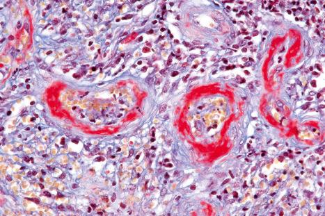 Fig. 6.43, Stasis dermatitis: there is marked mural fibrin deposition. The features often overlap with atrophie blanche.