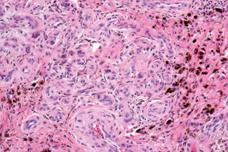 Fig. 6.44, Stasis dermatitis: in this view, there is marked new blood vessel formation and abundant hemosiderin is present.