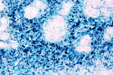 Fig. 6.45, Stasis dermatitis: the hemosiderin can be highlighted with a Prussian blue reaction for iron.