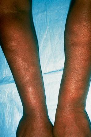 Fig. 6.47, Pityriasis alba: there are multiple hypopigmented, scaly patches on the arms. Lesions are more obvious in the colored races.