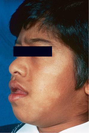 Fig. 6.48, Pityriasis alba: there is striking leukoderma on the cheek and chin, which are commonly affected sites.