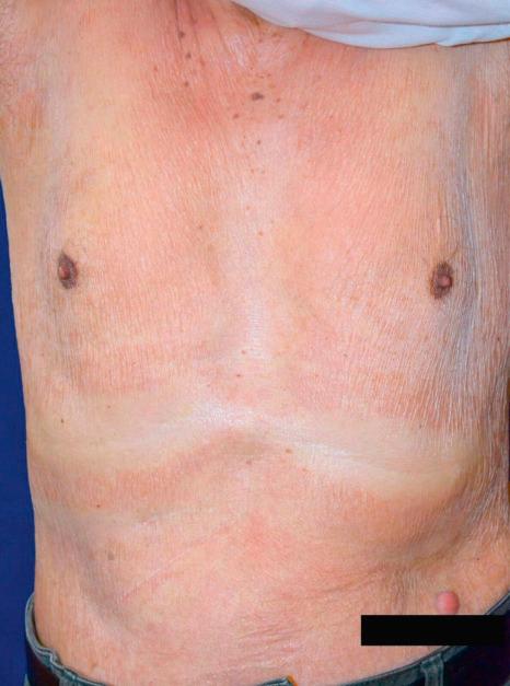 Fig. 6.50, Papuloerythrodermia of Ofuji: Erythrodermia and typical deck-chair sign.