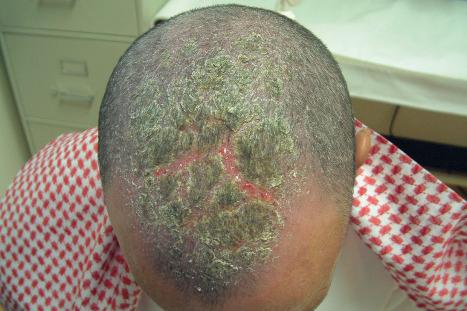 Fig. 6.5, Seborrheic dermatitis: there is diffuse erythema and scaling of the scalp.