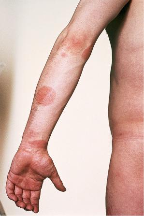 Fig. 6.7, Discoid eczema: circumscribed, erythematous lesions on the forearm, a characteristic site.