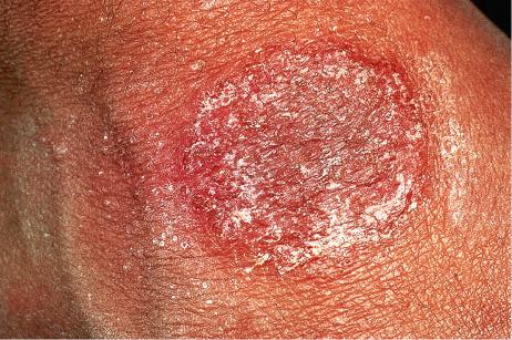 Fig. 6.8, Discoid eczema: the lesion is sharply defined and there is a pronounced scale.