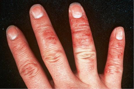 Fig. 6.10, Discoid eczema: lesions localized to the fingers most often represent a contact irritant reaction.