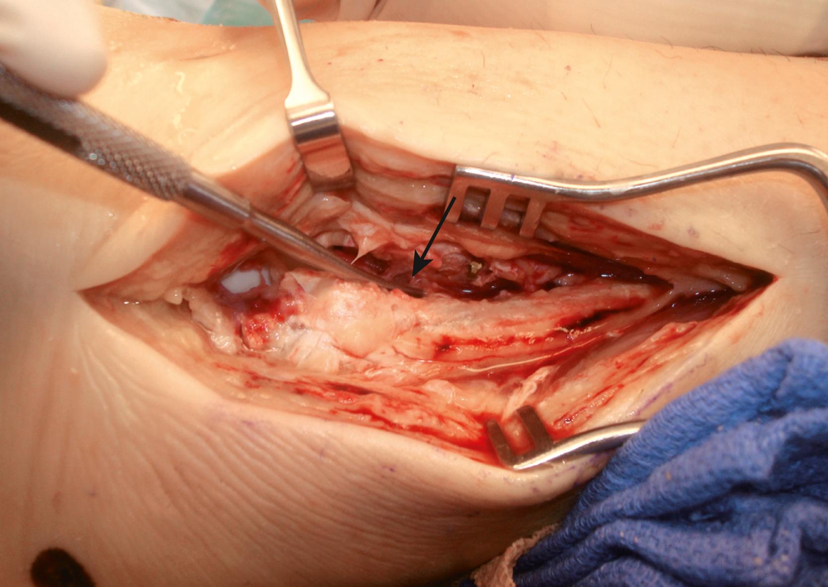 FIGURE 90.11, Disruption of the syndesmotic ligaments is directly visualized.