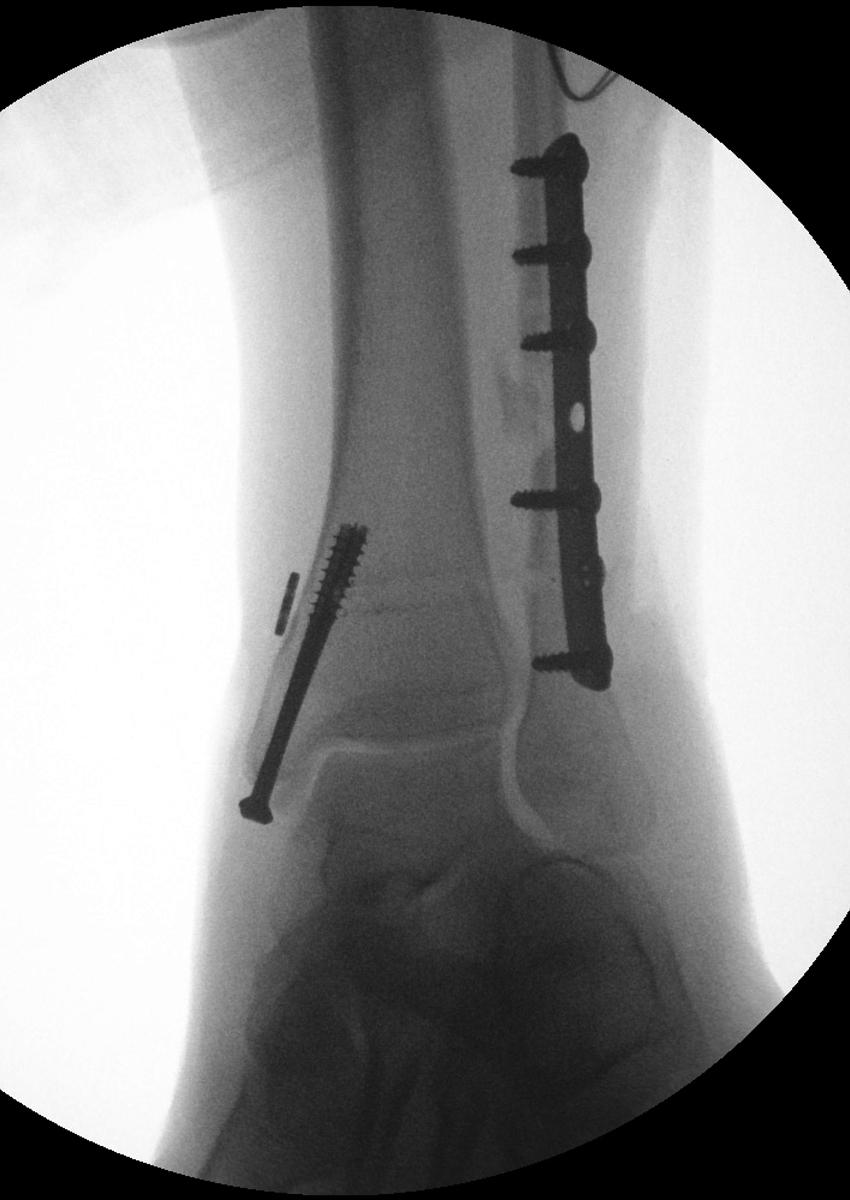 FIGURE 90.15, Fixation of syndesmosis with suture button.