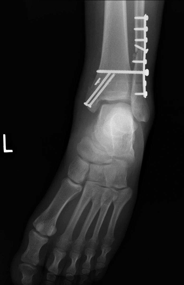 FIGURE 90.16, In young active individual who wishes to have syndesmosis screw removed, we often add suture button fixation to allow earlier removal of metal screw without risk of loss of reduction. Placement of syndesmotic screw across four cortices to allow retrieval from medial aspect of ankle in case of screw breakage. SEE TECHNIQUE 90.1.