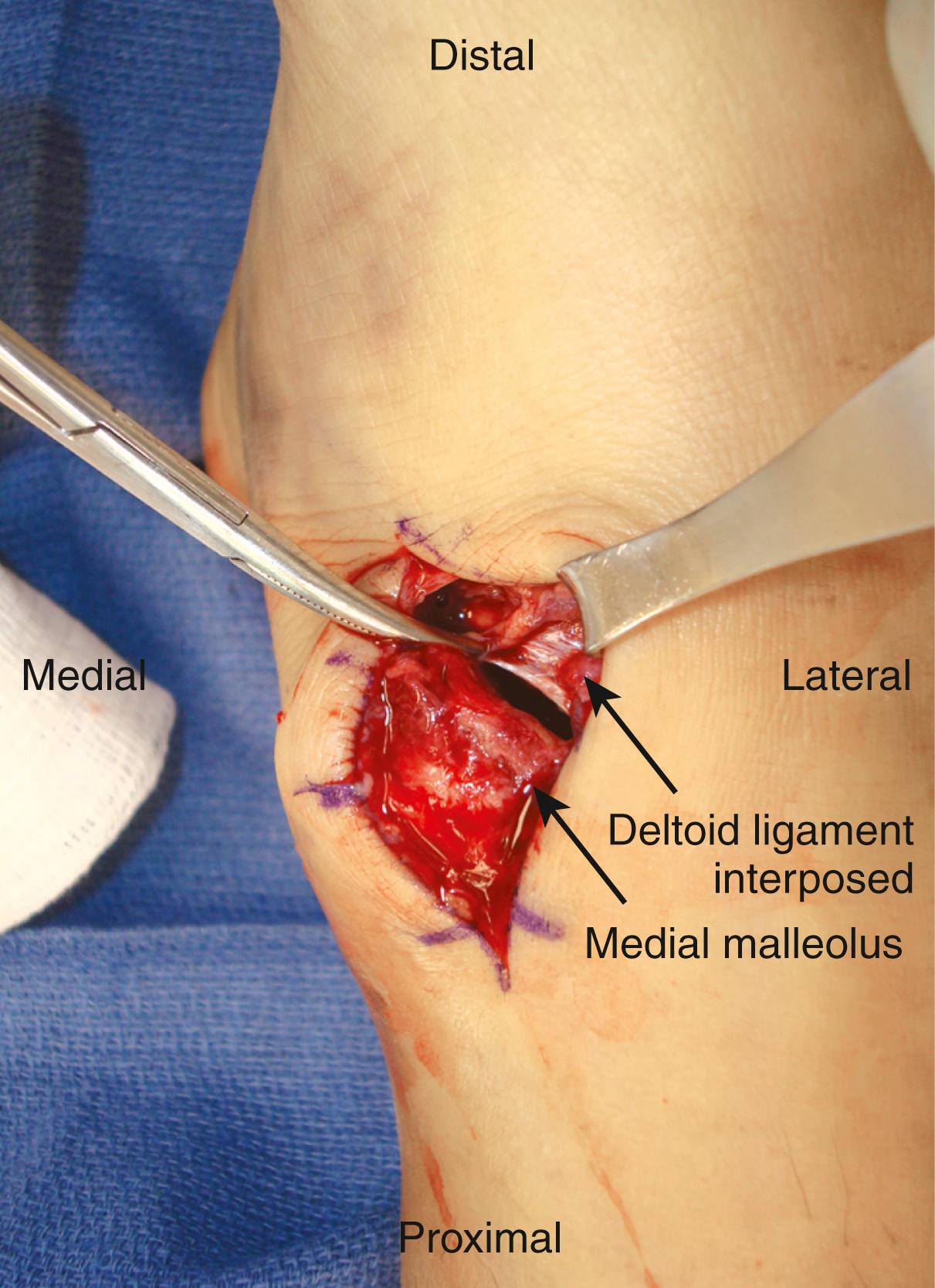 FIGURE 90.17, Deltoid ligament preventing reduction of ankle fracture-dislocation. SEE TECHNIQUE 90.1.