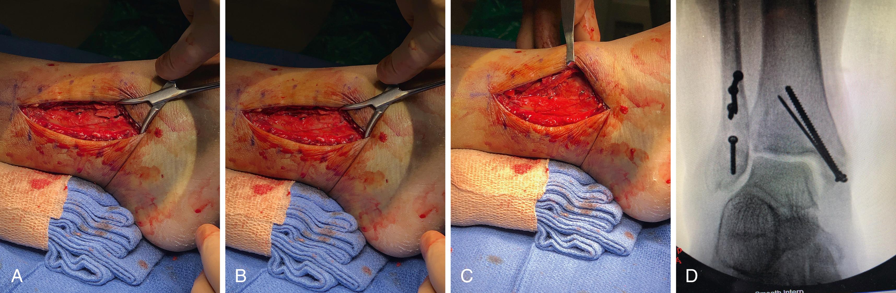 FIGURE 90.18, A-D , Repair of syndesmosis with fixation of Wagstaffe fracture.